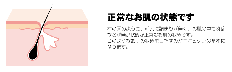 正常なお肌の状態です。左の図のように、毛穴に詰まりが無く、お肌の中も炎症などが無い状態が正常なお肌の状態です。このようなお肌の状態を目指すのがニキビケアの基本になります。