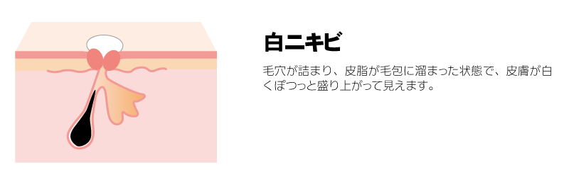 白ニキビ　毛穴が詰まり、皮脂が毛包に溜まった状態で、皮膚が白くぽつっと盛り上がって見えます。