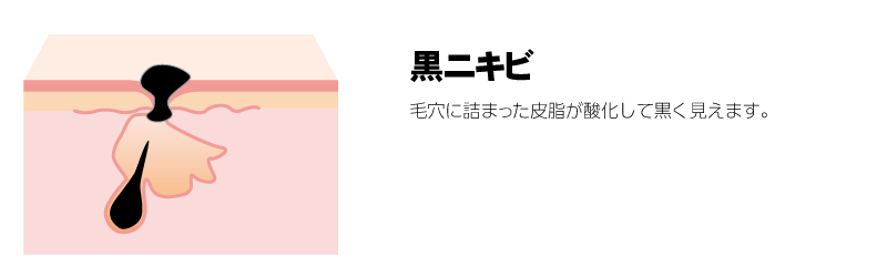 黒ニキビ　毛穴に詰まった皮脂が酸化して黒く見えます。