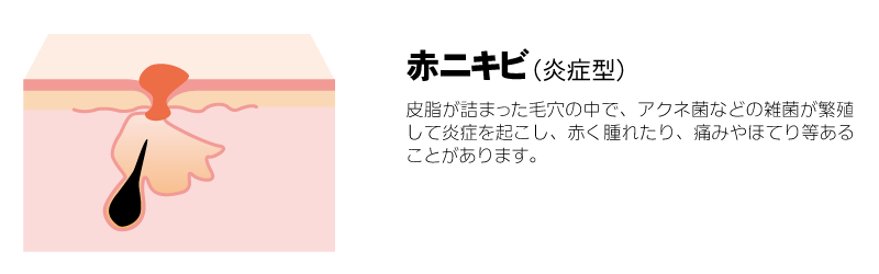 赤ニキビ（炎症型）　皮脂が詰まった毛穴の中で、アクネ菌などの雑菌が繁殖して炎症を起こし、赤く腫れたり、痛みやほてり等あることがあります。