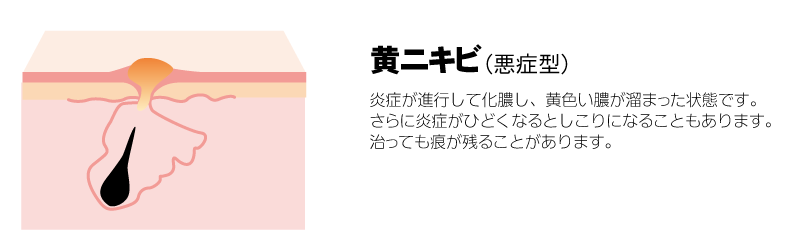 黄ニキビ（悪症型）　炎症が進行して化膿し、黄色い膿が溜まった状態です。さらに炎症がひどくなるとしこりになることもあります。治っても痕が残ることがあります。