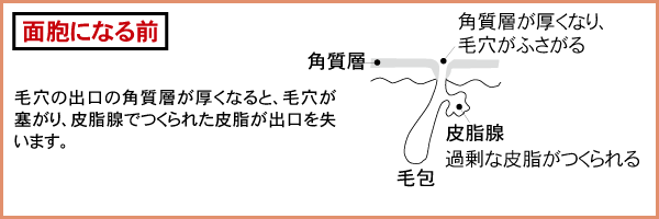 毛穴の出口の角質層が厚くなると、毛穴が塞がり、皮脂腺でつくられた皮脂が出口を失います。