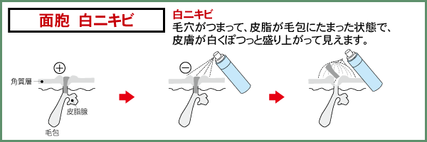 白ニキビ：毛穴がつまって、皮脂が毛包にたまった状態で、皮膚が白くぽつっと盛り上がって見えます。