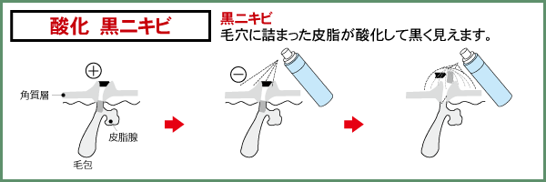 黒ニキビ：毛穴に詰まった皮脂が酸化して黒く見えます。