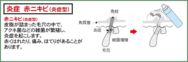 赤ニキビ（炎症型）：皮脂が詰まった毛穴の中で、アクネ菌などの雑菌が繁殖し、炎症を起こします。赤くはれたり、痛み、ほてりがあることがあります。