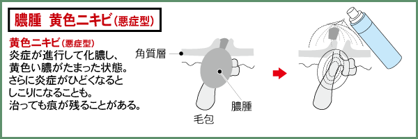 黄色ニキビ（悪症型）：炎症が進行して化膿し、黄色い膿がたまった状態。さらに炎症がひどくなるとしこりになることも。治っても痕が残ることがある。