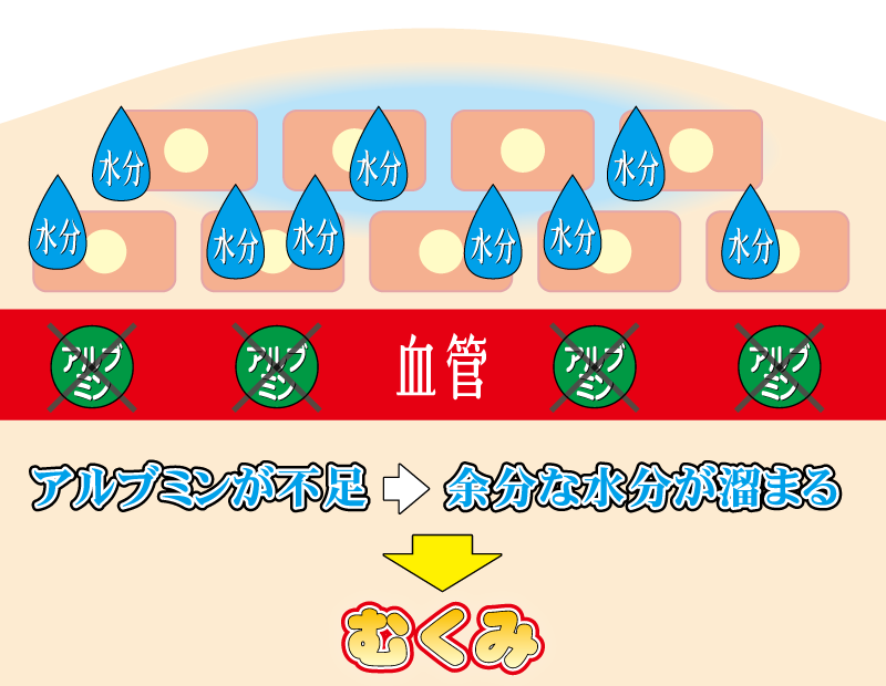 アルブミンが不足⇒余分な水分が溜まる⇒むくみ