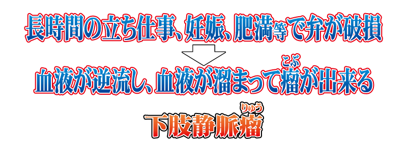 長時間の立ち仕事、妊娠、肥満などで便が破損し、血液が逆流し、血液が溜まって瘤ができることがあり、これが下肢静脈瘤です。