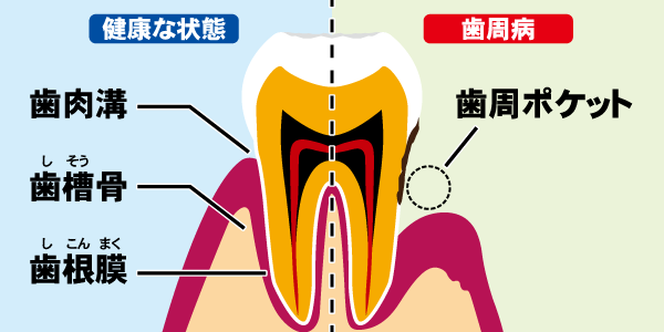 歯周病